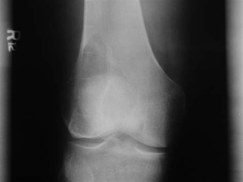 Tumor Symptoms: Bone Tumor Knee Symptoms