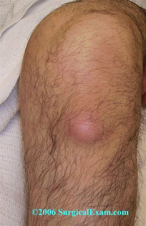 Tumor Symptoms: Tumor Behind Knee Symptoms