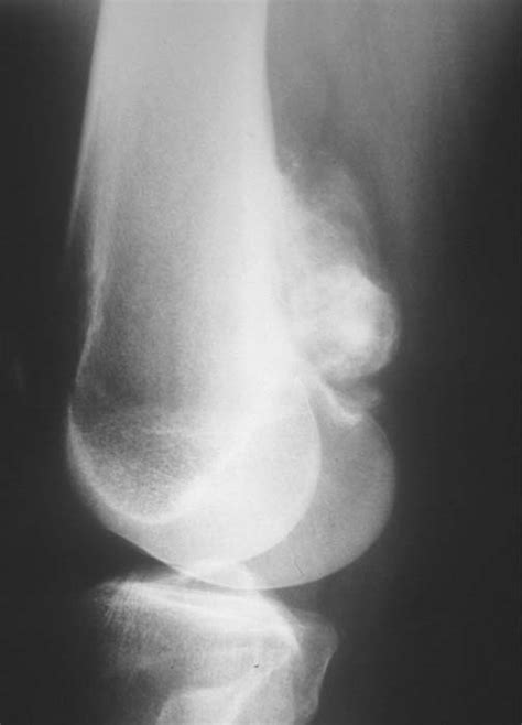 Tumor Symptoms: Tumor Knee Symptoms