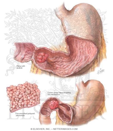 Tumor: Tumors In Stomach