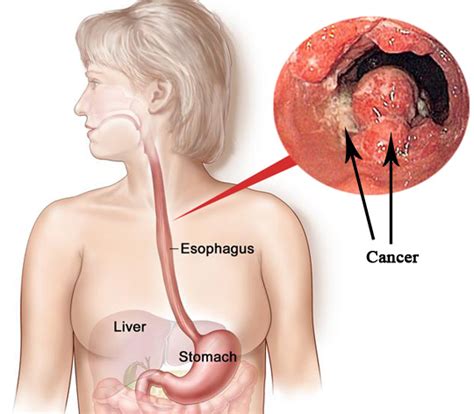 Tumore dell esofago: dalla clinica alla terapia chirurgica