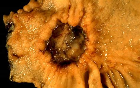 Tumore dello stomaco   Wikipedia