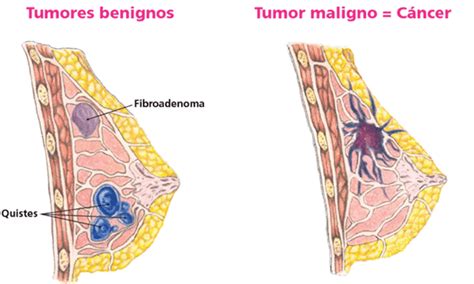 Tumores Benignos: mayo 2015