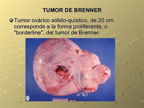 Tumores benignos ovario