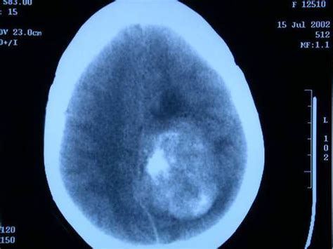 Tumores Cerebrales   Unidad de Neurocirugia RGS