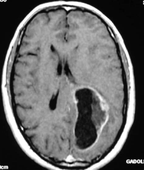 Tumores Cerebrales   Unidad de Neurocirugia RGS