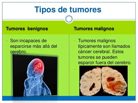 Tumores Cerebrales UP Med