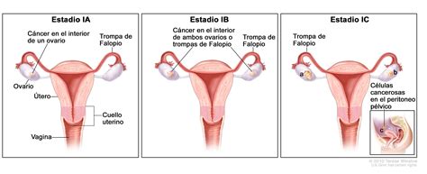 Tumores de células germinativas del ovario  PDQ® —Versión ...