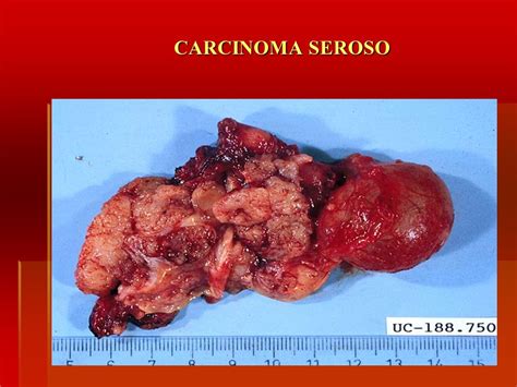 Tumores de Ovario Dra Alma Iris Ortiz M.   ppt descargar