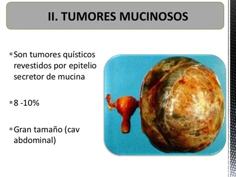 Tumores de ovario