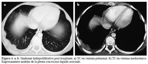 Tumores pulmonares en pediatría