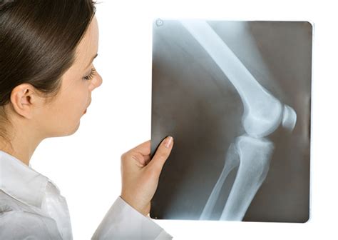 Tumores que destruyen el tejido óseo | Ciencia