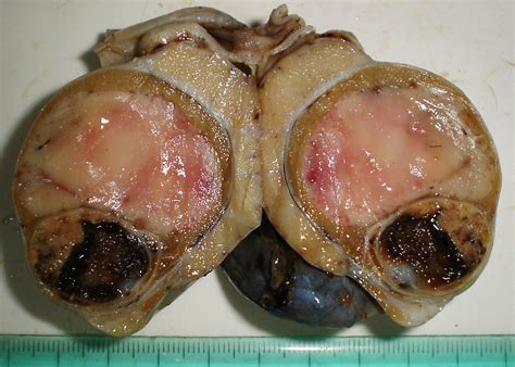 Tumores testiculares