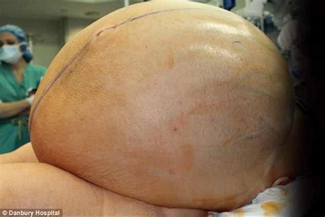 Twenty surgeons remove 132 pound ovarian tumor from woman ...