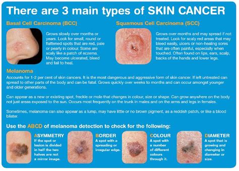 types of melanoma | Non melanoma skin cancer  NMSC  | My ...