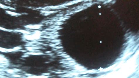 Ultrasonido de quiste en Ovario  Ovarian cyst ultrasound ...