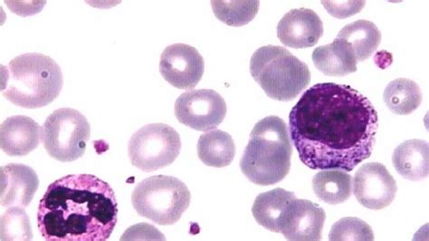 Un nueva terapia podría curar la leucemia mieloide crónica
