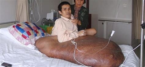 Un vietnamita operado de un tumor de 90 kilos en la pierna ...