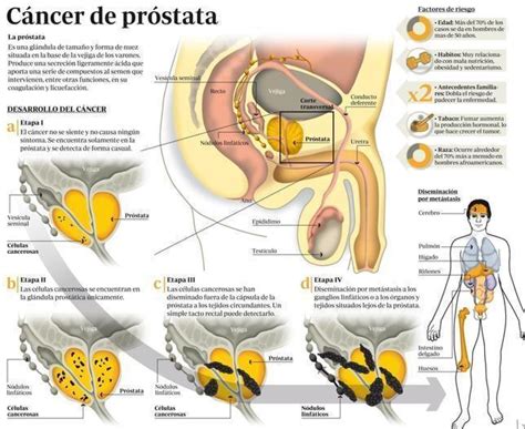 Una esperanza para tratar el cáncer de próstata