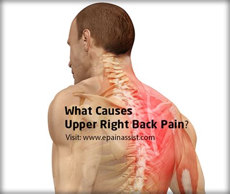 Upper Right Back Pain|Causes|Symptoms|Treatment|Diagnosis