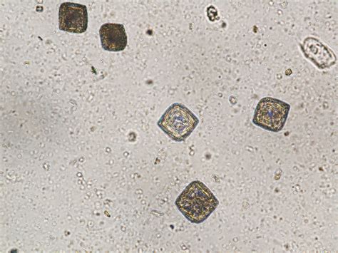 Uric Acid Crystals Images | www.imgkid.com   The Image Kid ...