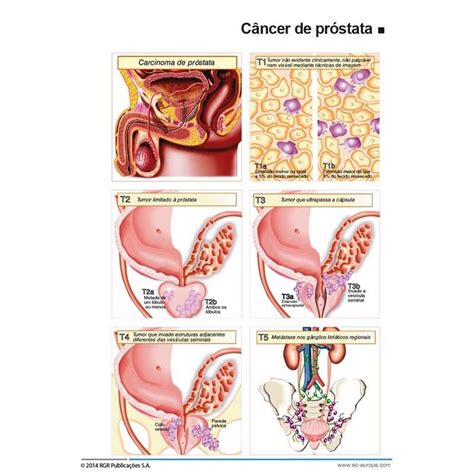 Urologia Oncológica   Tumores Urológicos   UROMED