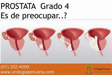 Urología Peruana: Dr. Susaníbar: Próstata de grado 4, debo ...