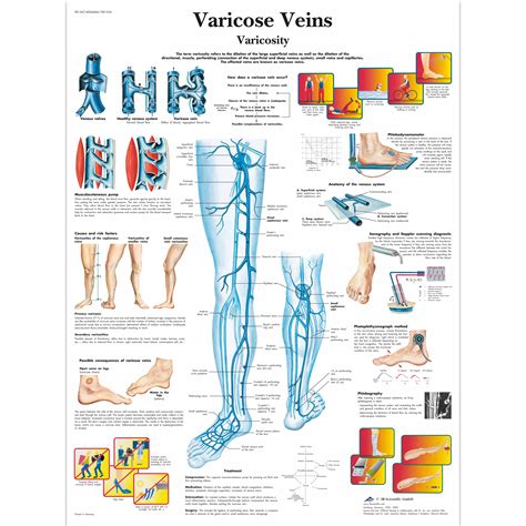 Varicose Veins Chart   4006684   VR1367UU   Cardiovascular ...