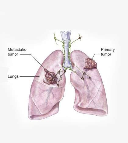 Various Options for Stage 4 Lung Cancer Treatment