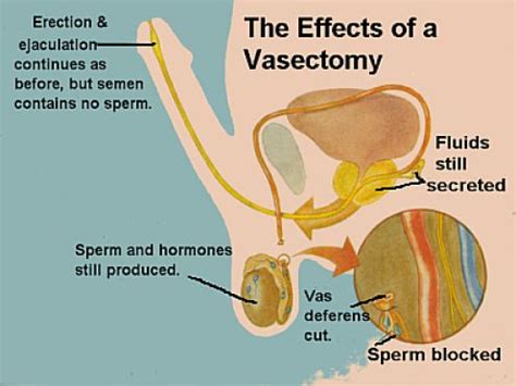 Vasectomy Procedure | Publish with Glogster!