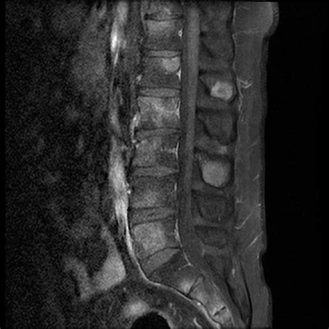 Vertebral metastases   lumbar spine | Image | Radiopaedia.org