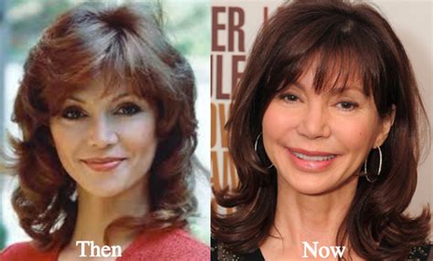 Victoria Principal Plastic Surgery Before and After Photos