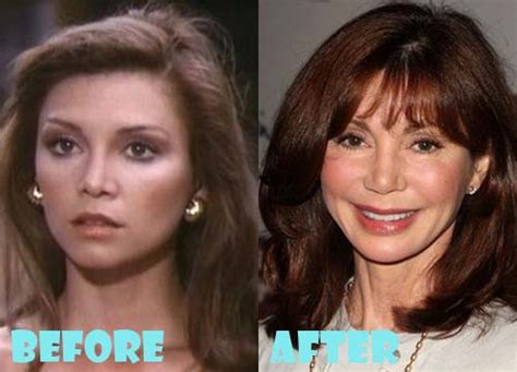 Victoria Principal Plastic Surgery Before and After Photos ...
