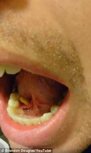 Video of man pushing an unpleasant looking  salivary stone ...