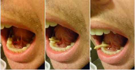 Watch this man push a  salivary stone  out of his mouth ...