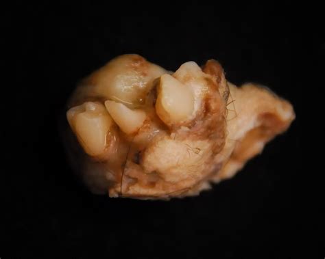 Well formed teeth visible in a mature cystic teratoma ...