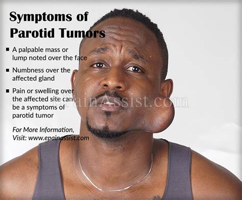 What are Parotid Tumors or Parotid Mass|Causes|Symptoms ...