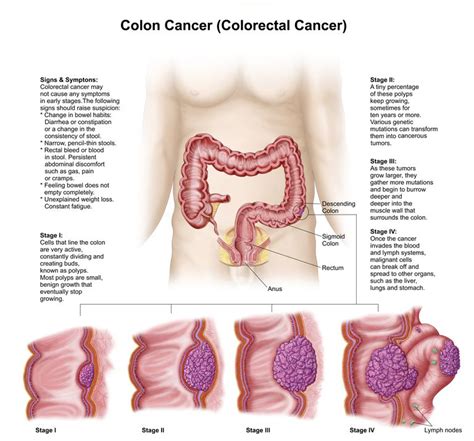 What Are The Stages of Colon and Rectal Cancer?