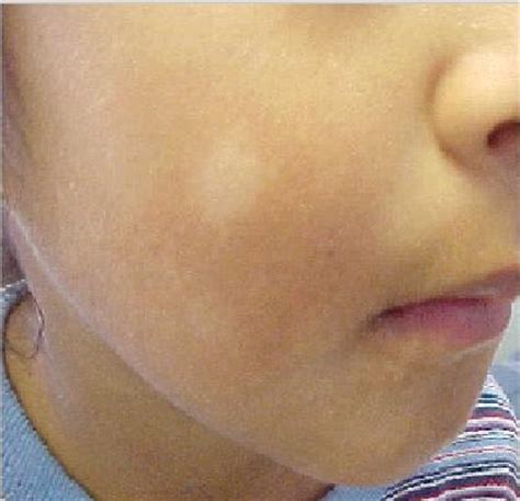 What Are Those White Spots on My Child’s Face? | My Two Hats