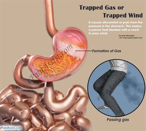 What Causes Trapped Gas Pain or Trapped Wind & Remedies to ...