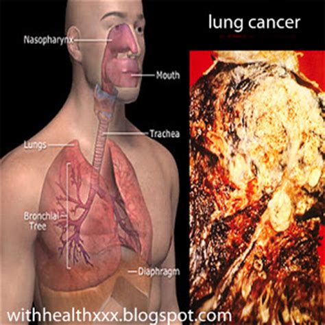 What Does it Mean Stage 4 Lung Cancer and Other Stage ...