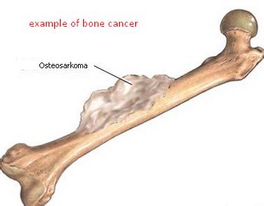 What is bone cancer treatments