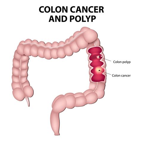 What is Colon Cancer   Colorectal Cancer Alliance ...