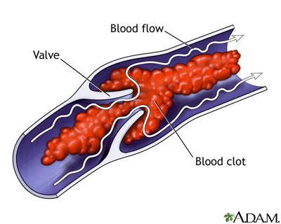 What is Factor V?   Factor V Leiden Thrombophilia