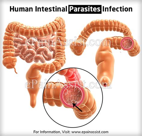 What is Human Intestinal Parasites Infection|Causes ...