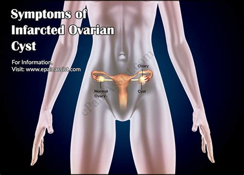 What is Infarcted Ovarian Cyst|Causes|Symptoms|Treatment ...