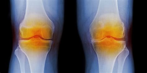 What is osteoarthritis? Causes, treatment and symptoms