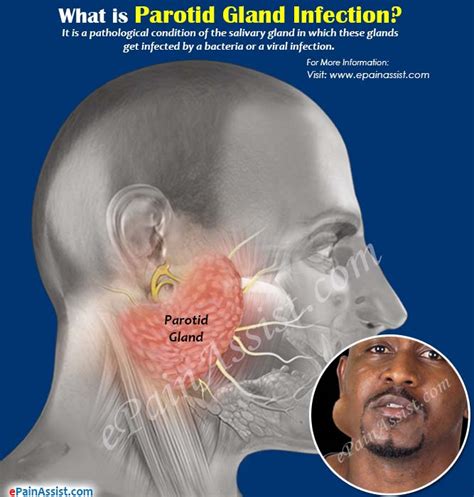 What is Parotid Gland Infection & How is it Treated?