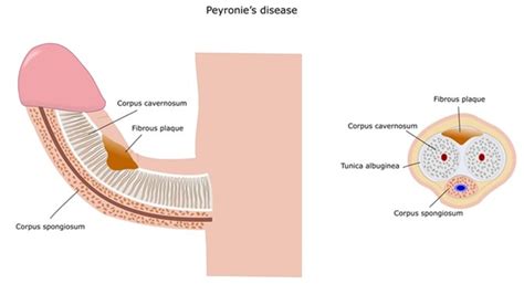 What is Peyronie’s Disease?