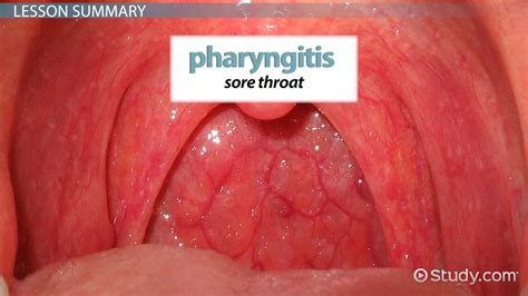 What Is Pharyngitis?   Definition, Causes, Symptoms ...